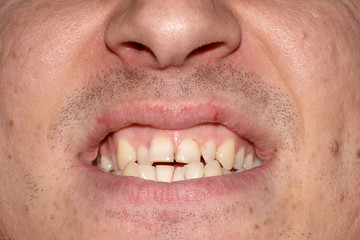 Mouth of man with crooked yellow overlap, crowding teeth close-up, decayed tooth. Not correct,...