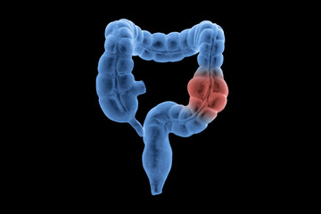 3D x-ray human large intestine cancer. Part of anatomy human body model with organ system.