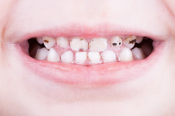 Dental medicine and healthcare - baby teeth with caries
