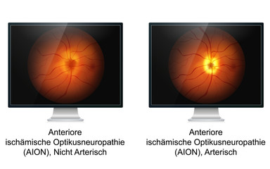 Anteriore ischämische Optikusneuropathie Unterschied