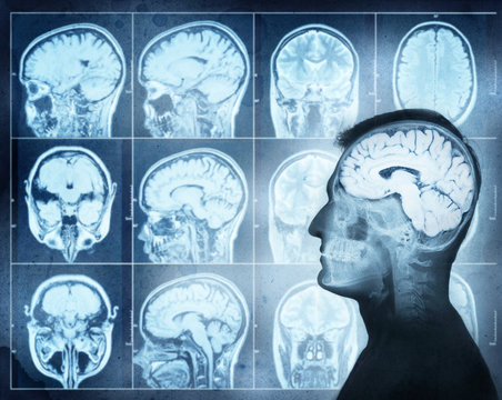 Conceptual image of a man from side profile showing brain  activity. Magnetic resonance image (MRI) of the brain