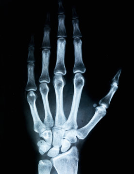 X-ray of human hand