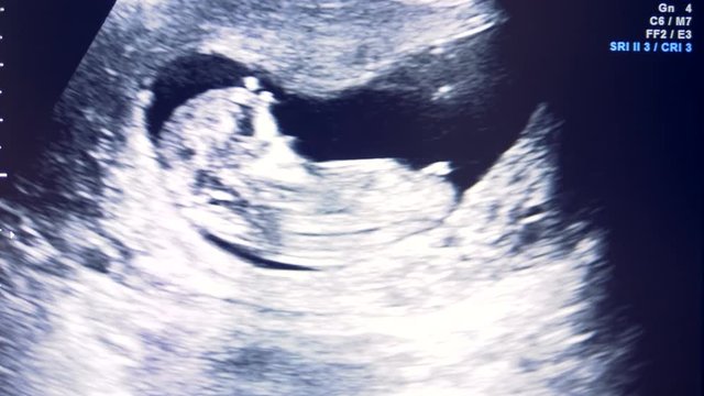 Embryo's development process displayed on a monitor during sonography