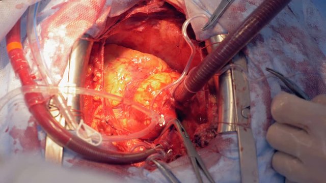Close up of a beating heart during surgery