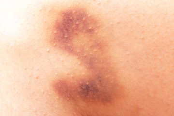 bruise on the skin - obrazy, fototapety, plakaty