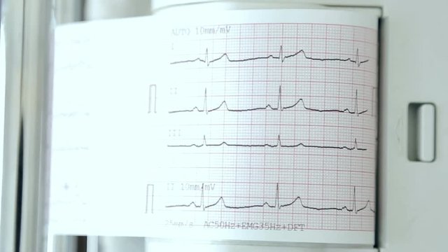 Doctor prints on the ECG ECG printer close-up