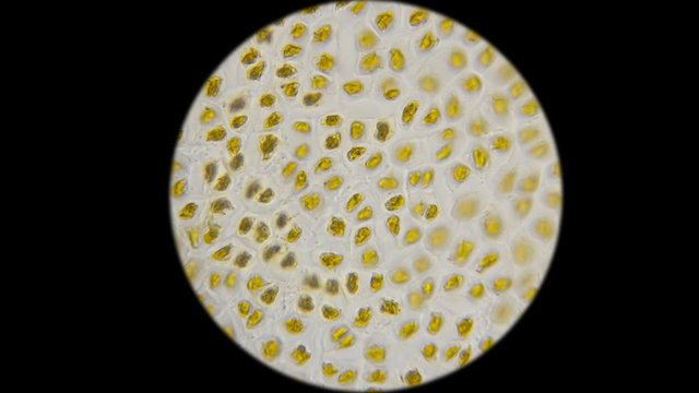 undigested cellulose of vegetables in the feces of the person under the microscope