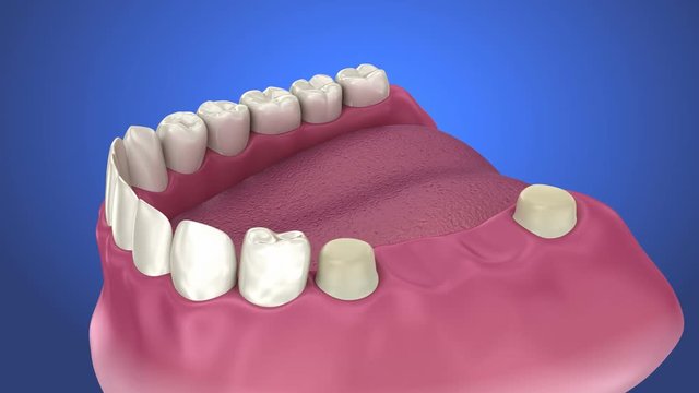 Tooth supported fixed bridge instalation process . Medically accurate 3D animation