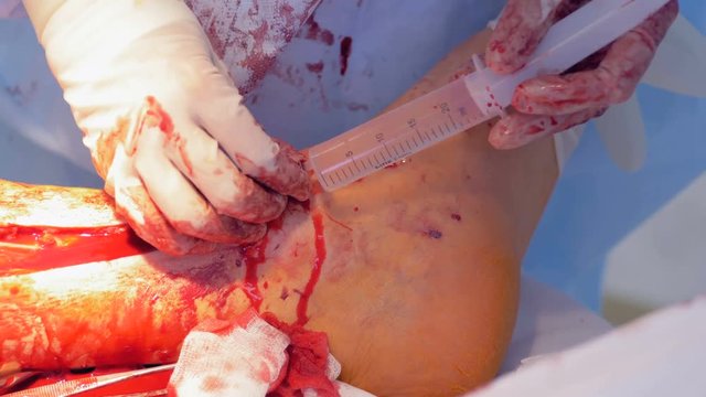 Process of catheterization of a vessel on a human leg