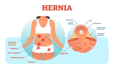 Hernia types vector illustration and cross section of muscle rupture and intestine.