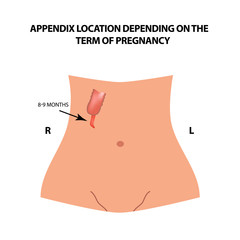 Obraz premium The location of the appendix depends on the term of pregnancy. 8-9 months. Infographics. Vector illustration on isolated background.