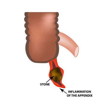 Inflammation of the appendix. Appendicitis. Gemstone. Infographics. Vector illustration on isolated background.