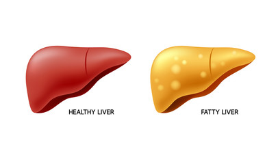 Comparison of healthy liver and fatty live. Liver Disease. Illustration info-graphic, isolated on white background.