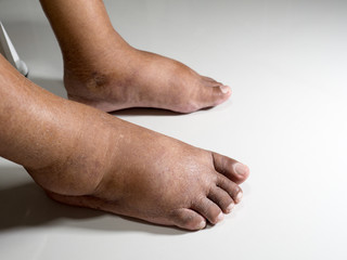 Fototapeta premium The feet of people with diabetes, dull and swollen. Due to the toxicity of diabetes placed on a white background.