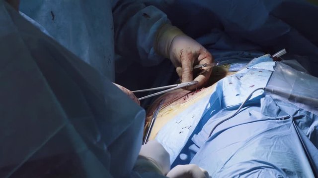Close up. Hands of the two surgeons suturing abdomen of the patient