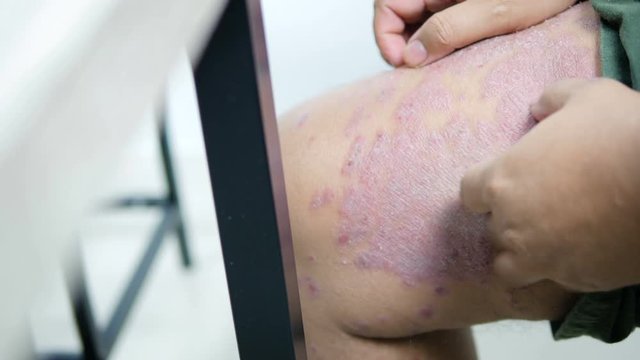 Hands of man scratching to leg skin rash psoriasis