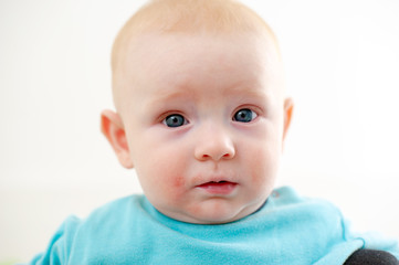 Allergies, atopic dermatitis on the face of a baby