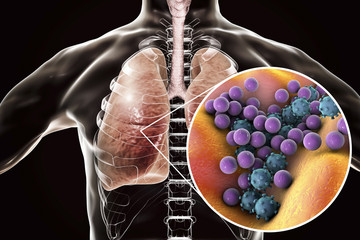 Pneumonia, medical concept, 3D illustration showing human lungs and close-up view of microbes in...