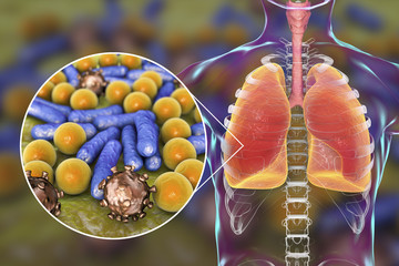 Pneumonia, medical concept, 3D illustration showing human lungs and close-up view of microbes in...