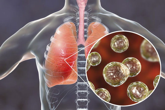 Blastomyces dermatitidis infection of lungs, conceptual image, 3D illustration