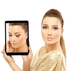 Post-Acne Marks /Treating Acne Scars.Acne Scar Removal