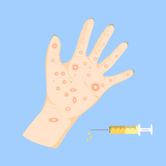Chicken pox on hand
