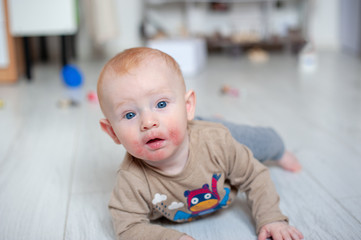 Traces of diathesis, allergies on baby's cheeks