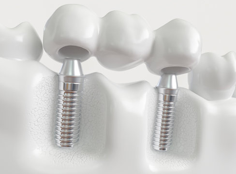 Implants with dental bridge - 3d rendering