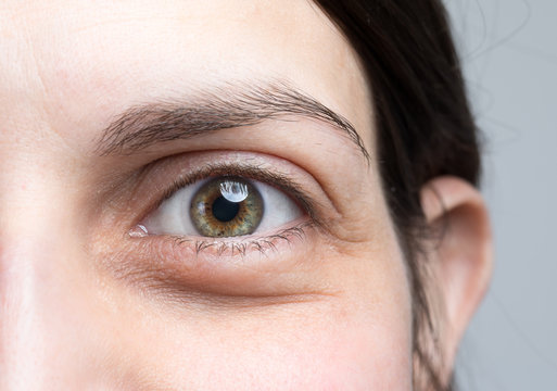 Macro image of woman puffy eye, female with eye bags