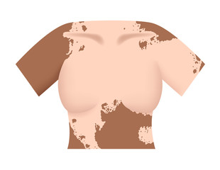 vitiligo on skin layer anatomy vector
