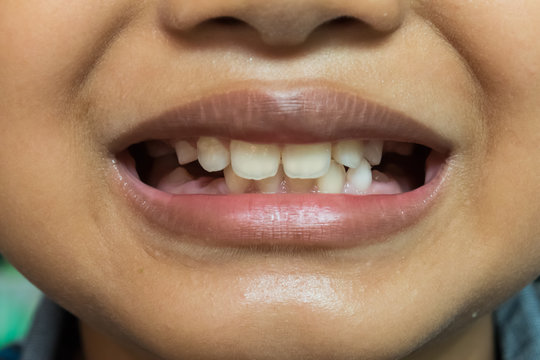 Selective focus of kid show broken tooth 