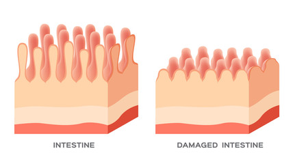 Celiac disease Small intestine lining damage. good and damaged villi . leaky gut progression