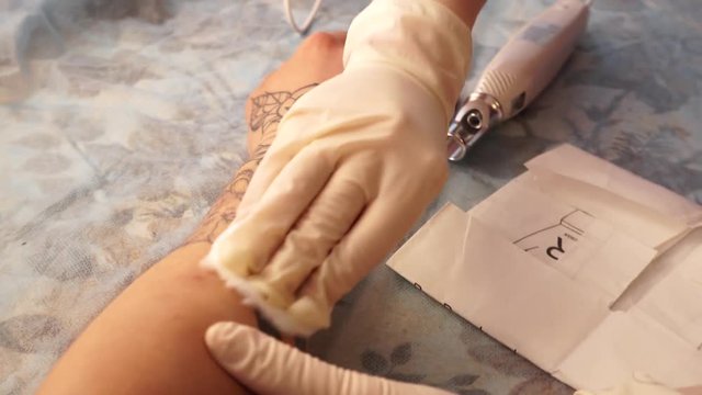 Tattoo removal laser. A young girl removes the tattoo with a laser.