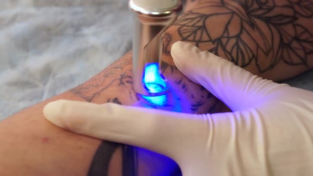 Tattoo removal laser. A young girl removes the tattoo with a laser.