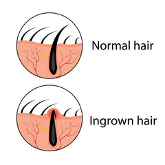 Normal and ingrown hair vector illustration