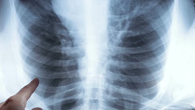 Doctor examining an x-ray of a patient's lungs. Healthy easy men in the picture