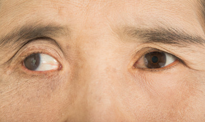 Fototapeta premium Abnormalities in the eyes