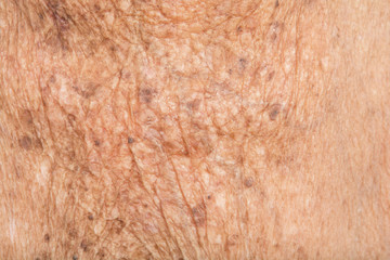 Skin of wrinkles in very old woman and Freckles on the face