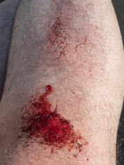 Grazed knee with blood of adult man with sports injury