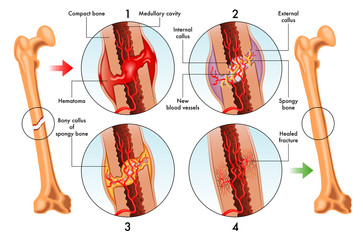 vector medical illustration of stages of bone fracture repair - obrazy, fototapety, plakaty