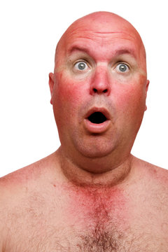 A Man Shocked At The Extent Of His Sun Burn.