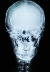 X-ray of human skull