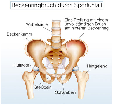 Beckenringbruch durch Sportunfall