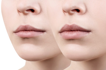 Lips of young woman before and after augmentation.
