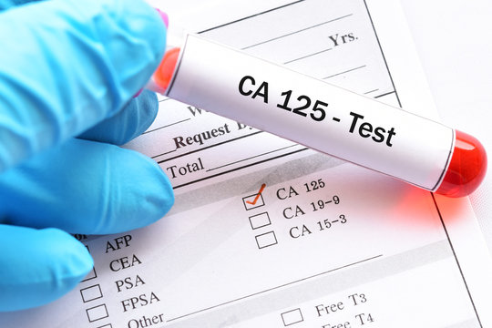 Blood sample for CA125 test, tumor marker for ovarian cancer