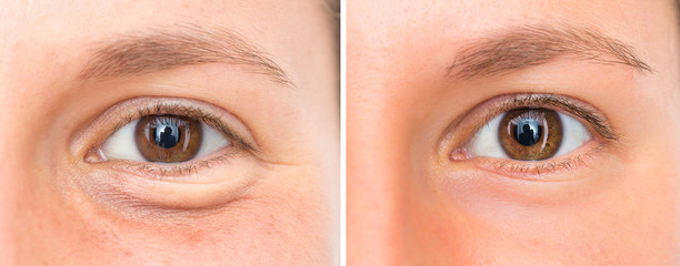 Girl face before and after blepharoplasty with and without eye bags