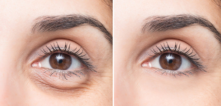 Woman eye before and after cosmetic treatment with and without eye bag