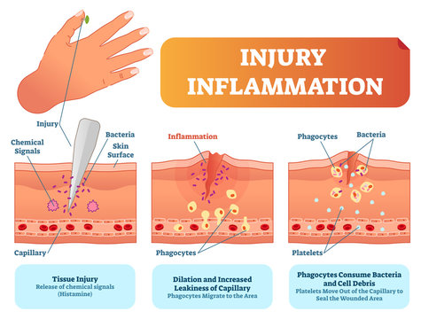 Injury Inflammation Biological Human Body Response Vector Illustration Scheme. Skin Surface Injury Cross Section Poster With Capillary, Phagocytes And Platelets.