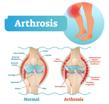Arthrosis medical vector illustration diagram with damaged knee structure and healthy knee comparison.