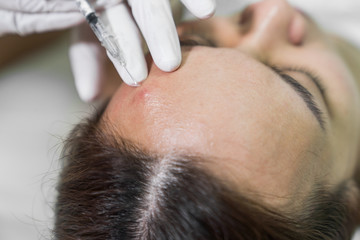 Obraz na płótnie Canvas Cosmetologist in spa beauty salon doing acne treatment using mechanical instrument.
